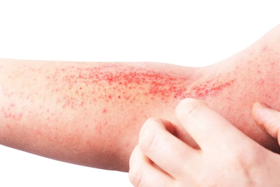 Mevsimi geldi, alerjik egzamaya dikkat