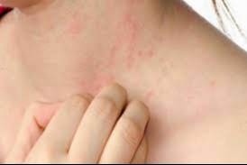 Dermatoloji uzmanı açıkladı: Uyuz hastalığının belirtileri nelerdir?