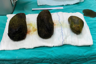 Karın ağrısı şikayetiyle hastaneye başvuran kadının midesinden 2 kilo saç çıktı