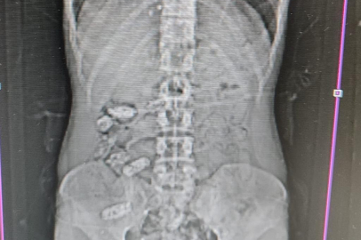Uyuşturucu kuryesinin midesinden 18 kapsül çıktı