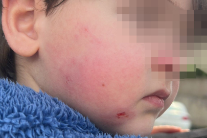 Kreşe bıraktığı çocuğunu darp edilmiş halde aldı